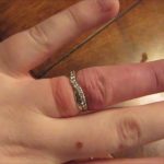 Что делать, если кольцо застряло на пальце эффективная помощь