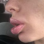 Уменьшение губ ужас, новый тренд или необходимость