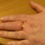 Как снять обручальное кольцо с отекшего пальца в домашних условиях, куда обращаться за помощью