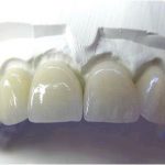 Преимущества зубных коронок